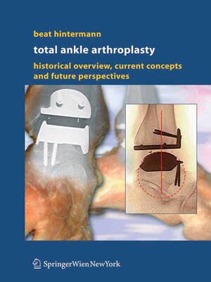 cover image of Total Ankle Arthroplasty